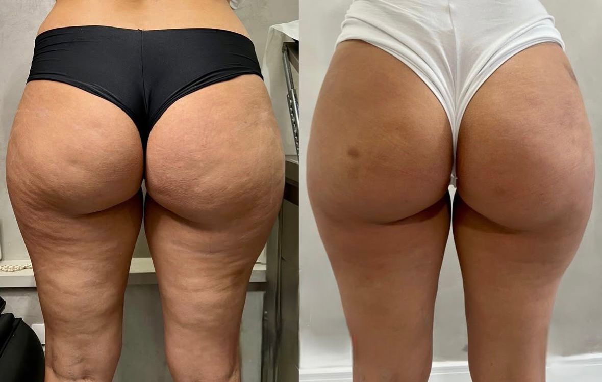 AntesDepois01